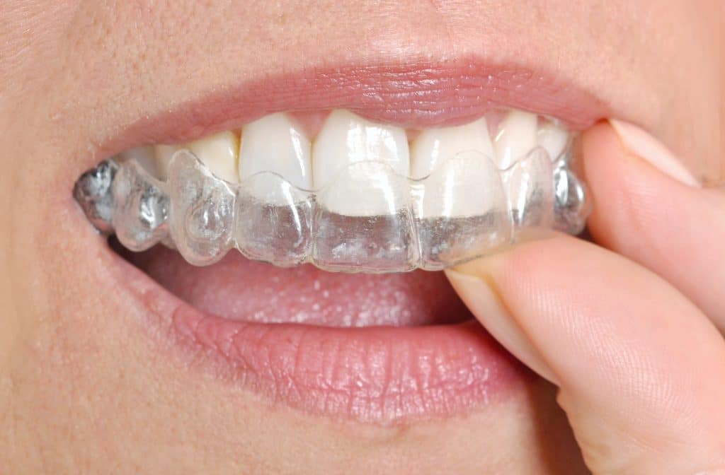 Woman putting in her invisible braces